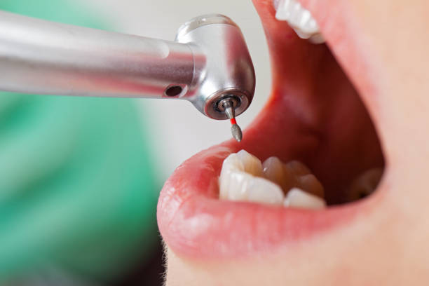 Best Emergency Wisdom Teeth Removal in Laverne, OK